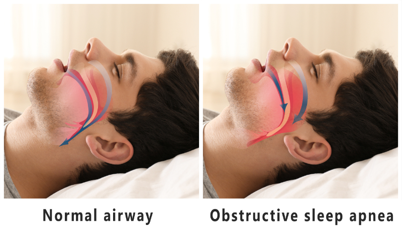 Sleep Apnea Treatment